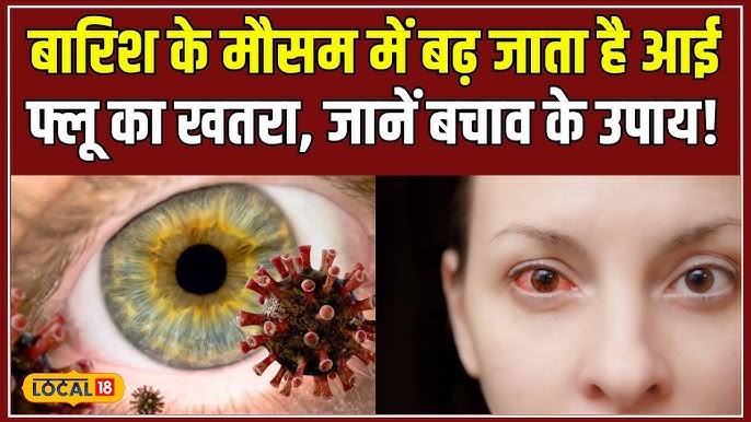 Monsoon Eye Infection: मानसून में बढ़ने लगता हैं आई फ्लू का खतरा, लाल आंख और जलन के मामलों में तेजी,बचाव के लिए अपनाये ये सारे उपाय