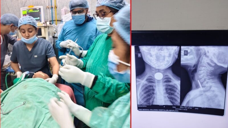 CG: सिम्स के डॉक्टरों ने बचाई 6 साल के मासूम की जान, अन्ननली में फंसा सिक्का जटिल ऑपरेशन से निकाला