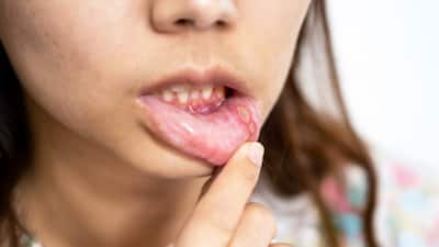 Health Tips: मुंह के छालों से हैं परेशान ? नमक के पानी से कुल्ला क्यों देता है राहत, जानिए इसके पीछे का वैज्ञानिक कारण